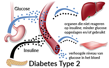 Schematische weergave van diabetes type 2